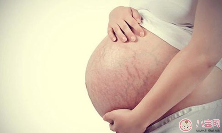 孕婦妊娠紋怎么預防 孕婦預防妊娠紋吃什么