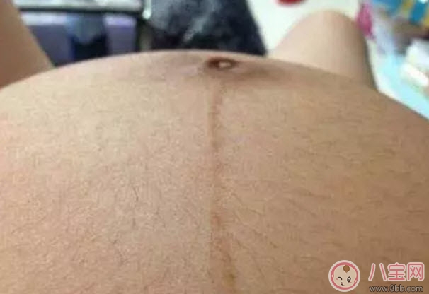 孕婦懷孕后身體哪個部位容易變黑呢 孕婦變黑對寶寶會有什么影響嗎