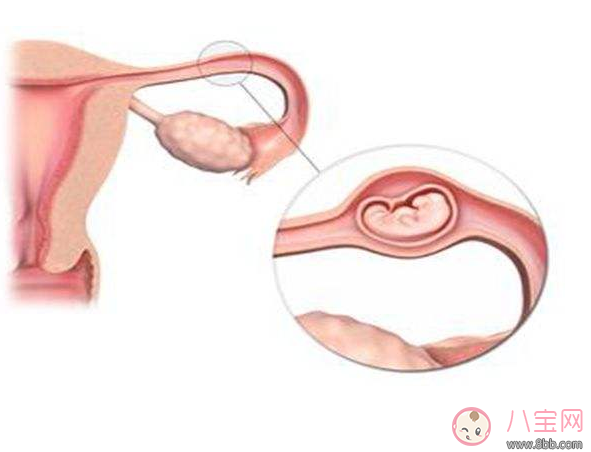 導(dǎo)致宮外孕危害相當(dāng)大 生活中這樣做可以預(yù)防