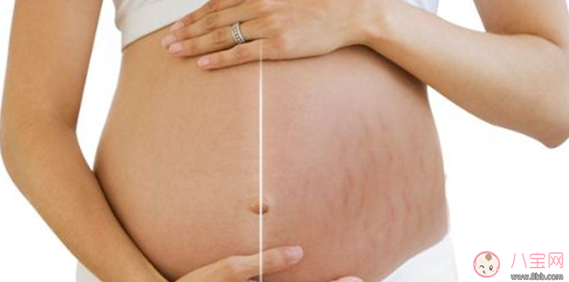 這些人居然天生不長(zhǎng)妊娠紋 不長(zhǎng)妊娠紋的奧秘是什么 這些人居然天生不長(zhǎng)妊娠紋 不長(zhǎng)妊娠紋的奧秘是什么