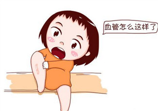 孕婦靜脈曲張是怎么回事 孕婦靜脈曲張?jiān)趺淳徑? data-yjug=