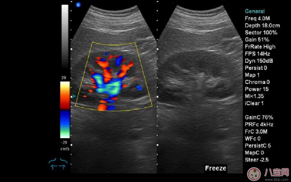 b超和彩超的區(qū)別 什么情況下使用普通B超或彩超 b超和彩超的區(qū)別 什么情況下使用普通B超或彩超