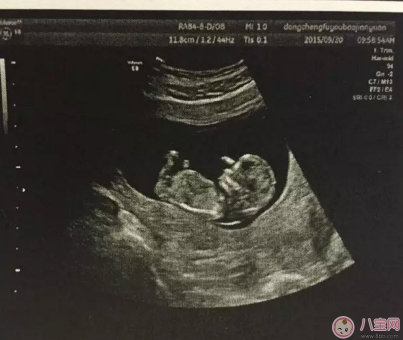 b超和彩超的區(qū)別 什么情況下使用普通B超或彩超 b超和彩超的區(qū)別 什么情況下使用普通B超或彩超