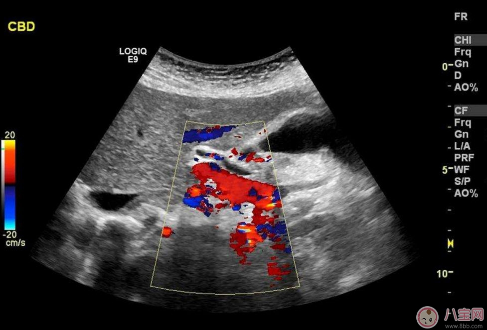 b超和彩超的區(qū)別 什么情況下使用普通B超或彩超 b超和彩超的區(qū)別 什么情況下使用普通B超或彩超