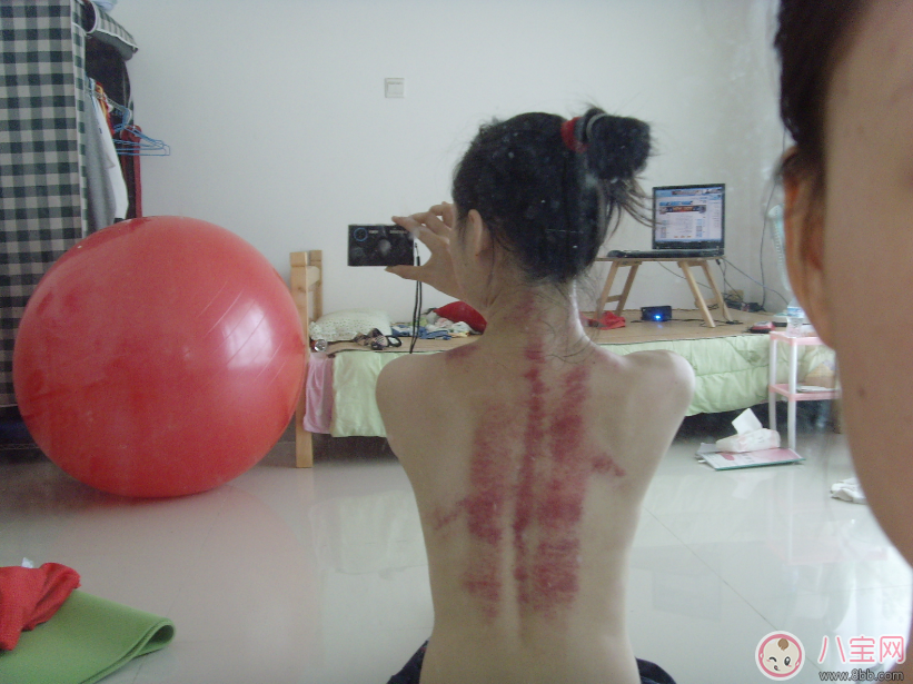 孕婦抓痧會流產(chǎn)嗎 中暑能抓痧嗎