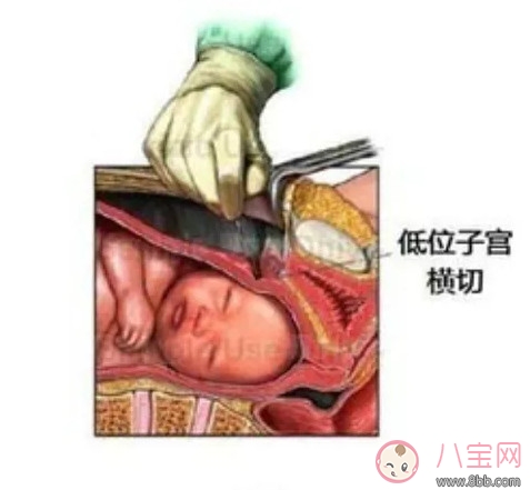 剖腹產(chǎn)孕婦會不會感到疼痛 剖腹產(chǎn)橫剖還是縱剖。
