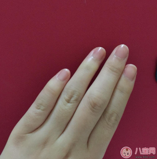 手上長這個千萬不要撕 倒刺的正確處理方法