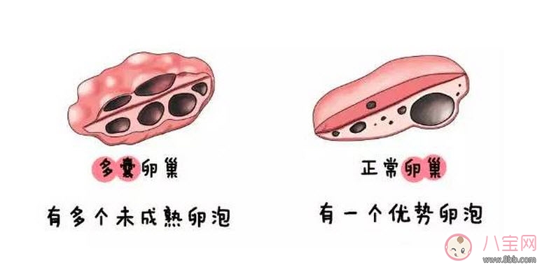 昆凌三胎計劃，昆凌多囊性卵巢癥候群是什么病