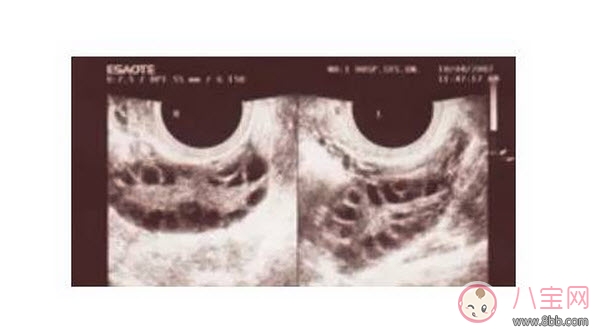 昆凌三胎計劃，昆凌多囊性卵巢癥候群是什么病