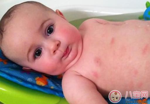 這些情況居然是奶粉過敏 怎么知道孩子吃奶粉過敏了 這些情況居然是奶粉過敏 怎么知道孩子吃奶粉過敏了