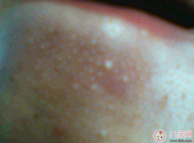 抿嘴時下巴上面的白色小顆粒是不是粉刺