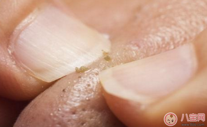 抿嘴時下巴上面的白色小顆粒是不是粉刺