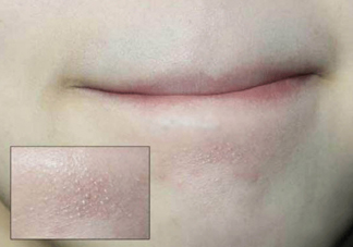 抿嘴時下巴上面的白色小顆粒是不是粉刺