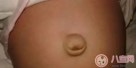 孩子肚臍臟了怎么辦 就算你有強(qiáng)迫癥也不能摳