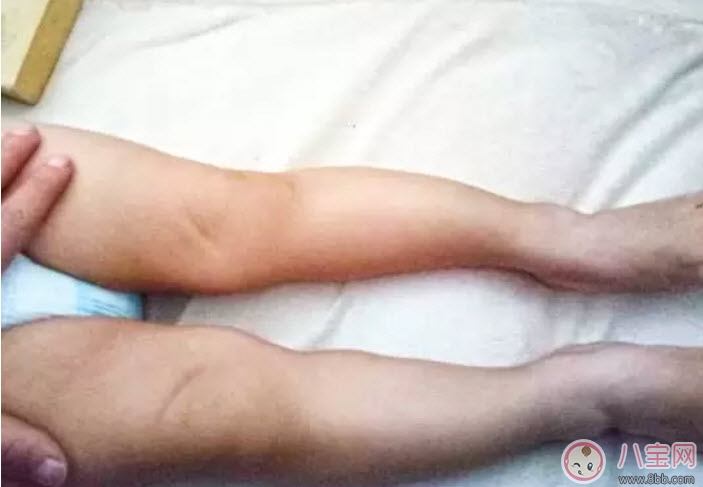 嬰兒為什么是青蛙腿 寶寶青蛙腿用不用綁腿