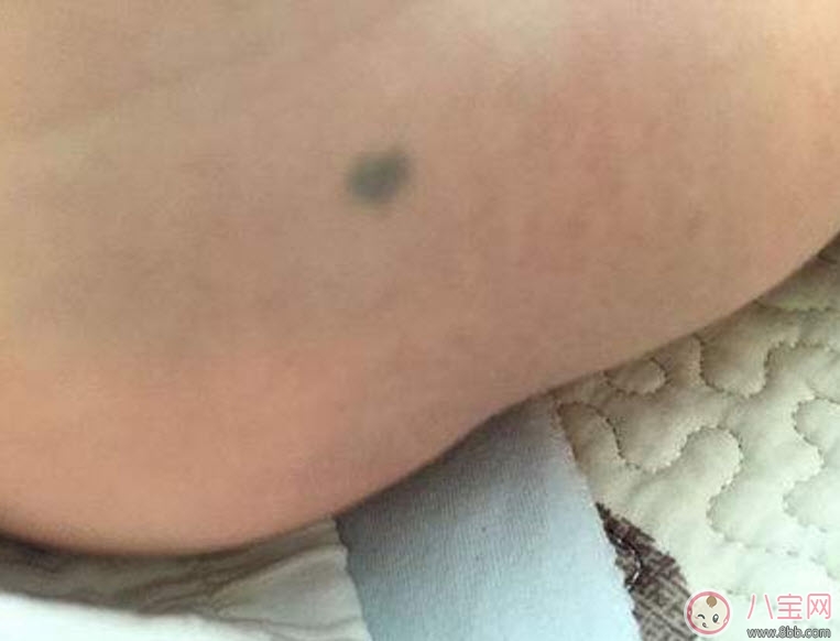 嬰兒屁股下面有胎記有什么含義 新生兒寶寶屁股下面有胎記好不好