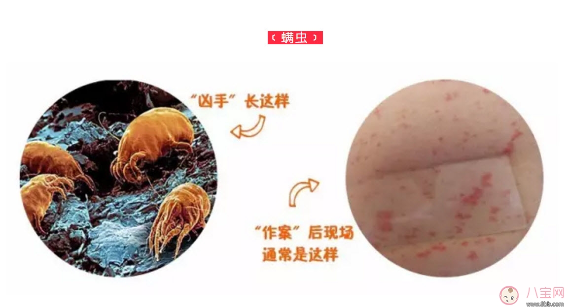 寶寶螨蟲過敏怎么辦，寶寶被螨蟲咬和蚊子咬癥狀對比圖片區(qū)別