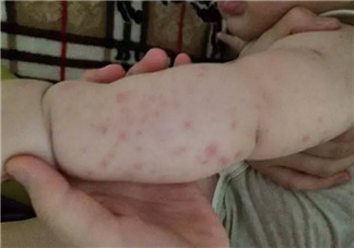 寶寶螨蟲過敏怎么辦，寶寶被螨蟲咬和蚊子咬癥狀對比圖片區(qū)別