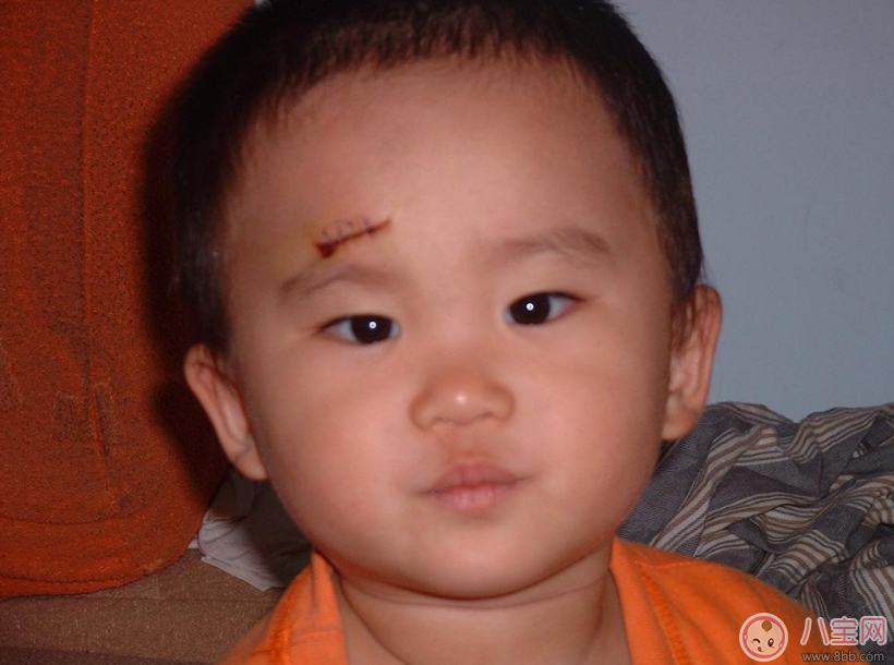 孩子受傷怎么做不留疤 傷口不留疤處理方法