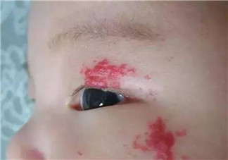 寶寶胎記多大治療最好 寶寶治療胎記的最佳時(shí)間