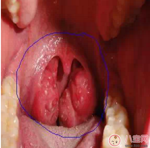 寶寶扁桃體炎表現(xiàn) 如何預(yù)防小兒扁桃體炎