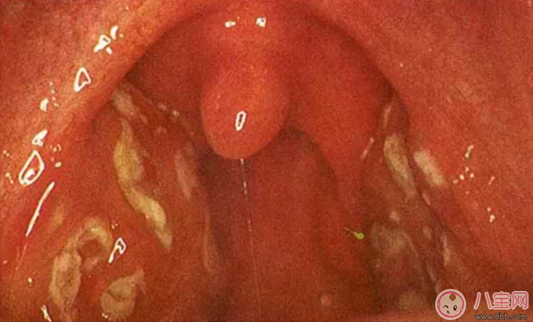 寶寶扁桃體炎表現(xiàn) 如何預(yù)防小兒扁桃體炎