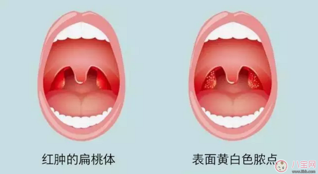 寶寶扁桃體炎表現(xiàn) 如何預(yù)防小兒扁桃體炎