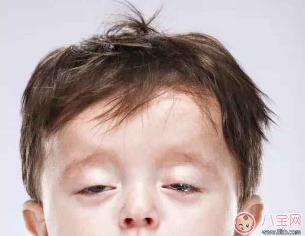 嬰兒鬼臉綜合癥癥狀圖有哪些 過量補(bǔ)鈣造成鬼臉綜合癥的危害是什么