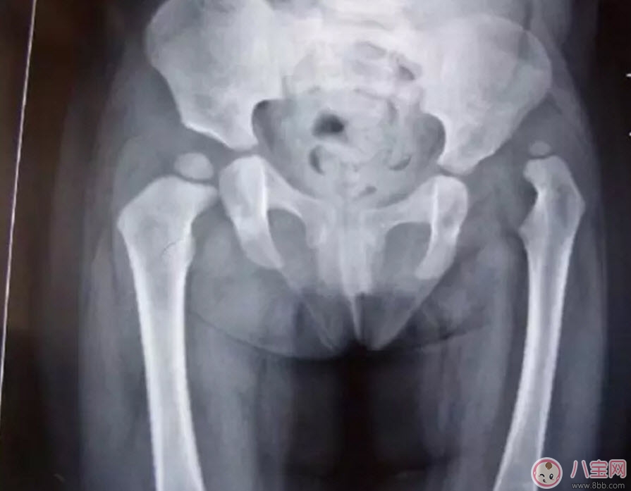 寶寶臀紋不對稱怎么回事 臀紋不對稱一定是髖關(guān)節(jié)發(fā)育不良嗎