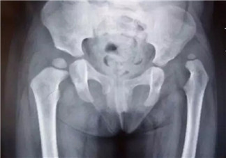 寶寶臀紋不對(duì)稱怎么回事 臀紋不對(duì)稱一定是髖關(guān)節(jié)發(fā)育不良嗎