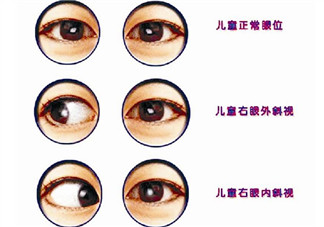 寶寶斜視手術(shù)風(fēng)險大嗎 寶寶斜視一定要做手術(shù)嗎