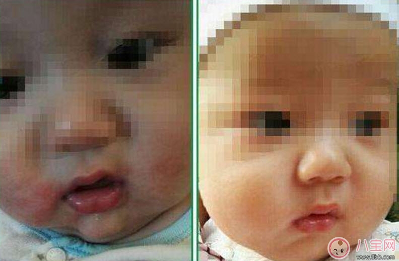 寶寶嘴角邊長濕疹怎么辦 寶寶嘴角濕疹是什么原因