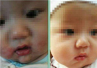 寶寶嘴角邊長(zhǎng)濕疹怎么辦 寶寶嘴角濕疹是什么原因