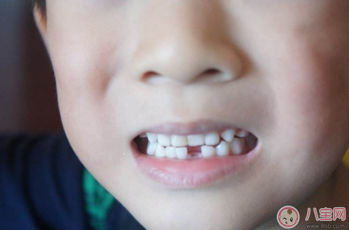 孩子換牙牙不掉 孩子雙排牙要不要拔