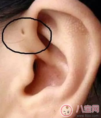 孩子耳朵上面有小孔是什么 耳朵的小孔是富貴孔嗎