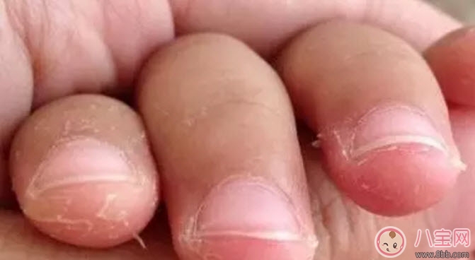 新生兒手腳脫皮要多久 新生兒脫皮怎么護(hù)理(能搽點(diǎn)什么)