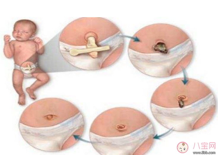 新生兒臍帶消毒用什么 臍帶消毒用碘伏好還是酒精(肚臍消毒圖解)