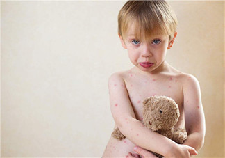 寶寶長水痘的原因 如何發(fā)現(xiàn)寶寶長水痘