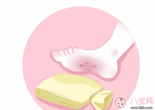 寶寶燙傷怎么辦 寶寶燙傷急救處理方法