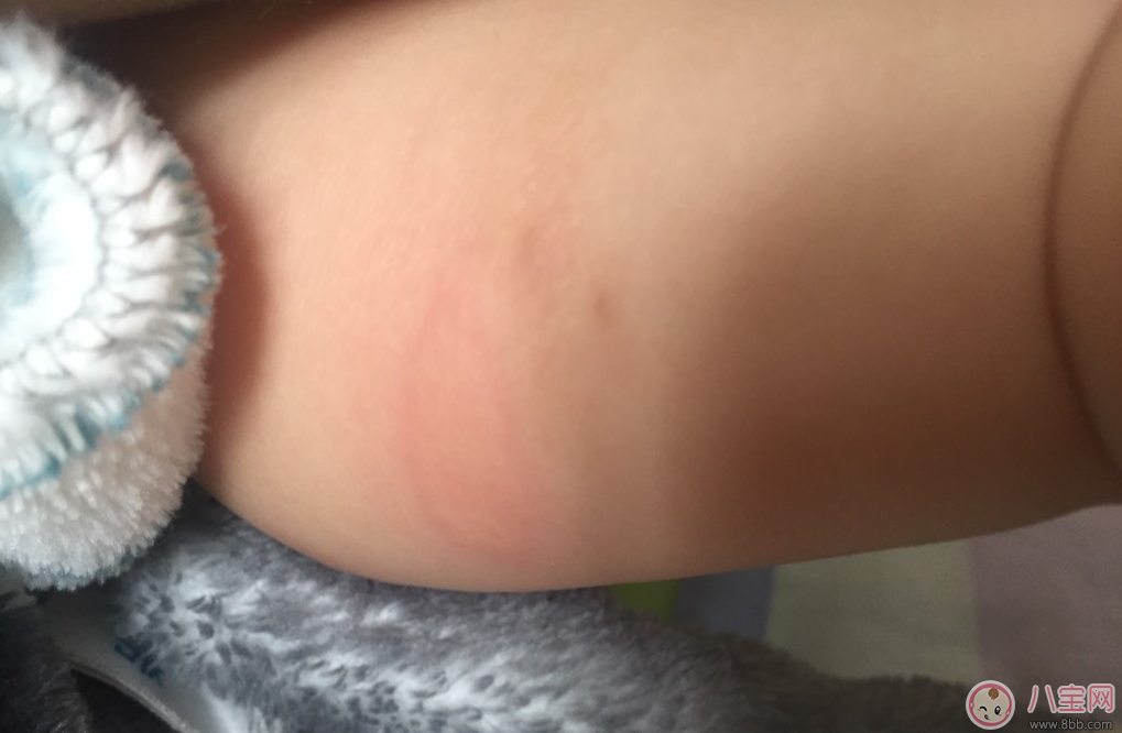 夏日寶寶身上起很大的包是怎么回事 怎么給孩子去風(fēng)疙瘩