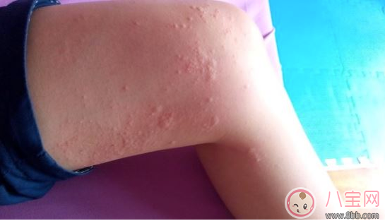 孩子玫瑰疹怎么護理 細(xì)心護理好得快