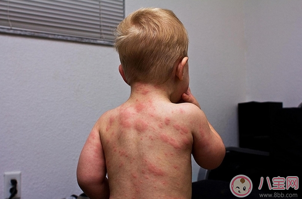 孩子玫瑰疹怎么護理 細(xì)心護理好得快