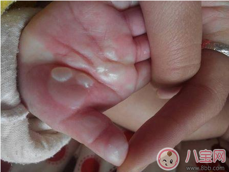 孩子燙傷后抹醬油有效嗎 這些偏方燙傷后千萬(wàn)不要學(xué)