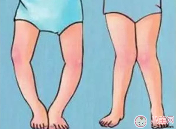 小兒佝僂病的癥狀 小兒佝僂病的預防治療