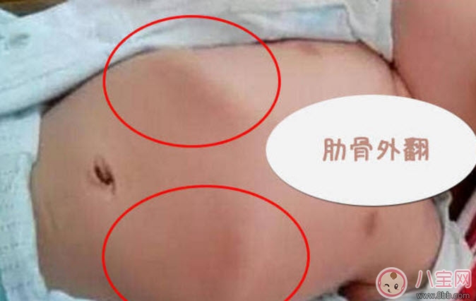 寶寶肋骨外翻的癥狀有哪些 寶寶肋骨外翻怎么辦