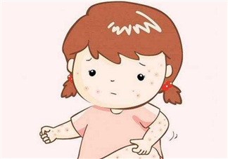 寶寶長痱子怎么辦 給寶寶去痱子的方法有哪些