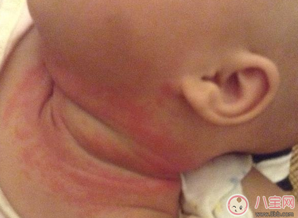 夏天寶寶脖子被淹和起痱子的區(qū)別在哪里(圖文)