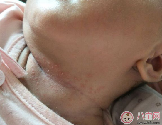 夏天寶寶脖子被淹和起痱子的區(qū)別在哪里(圖文)