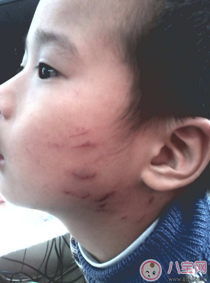 孩子經(jīng)常性的抓人怎么辦 孩子抓人多半是因?yàn)榧彝? alt=