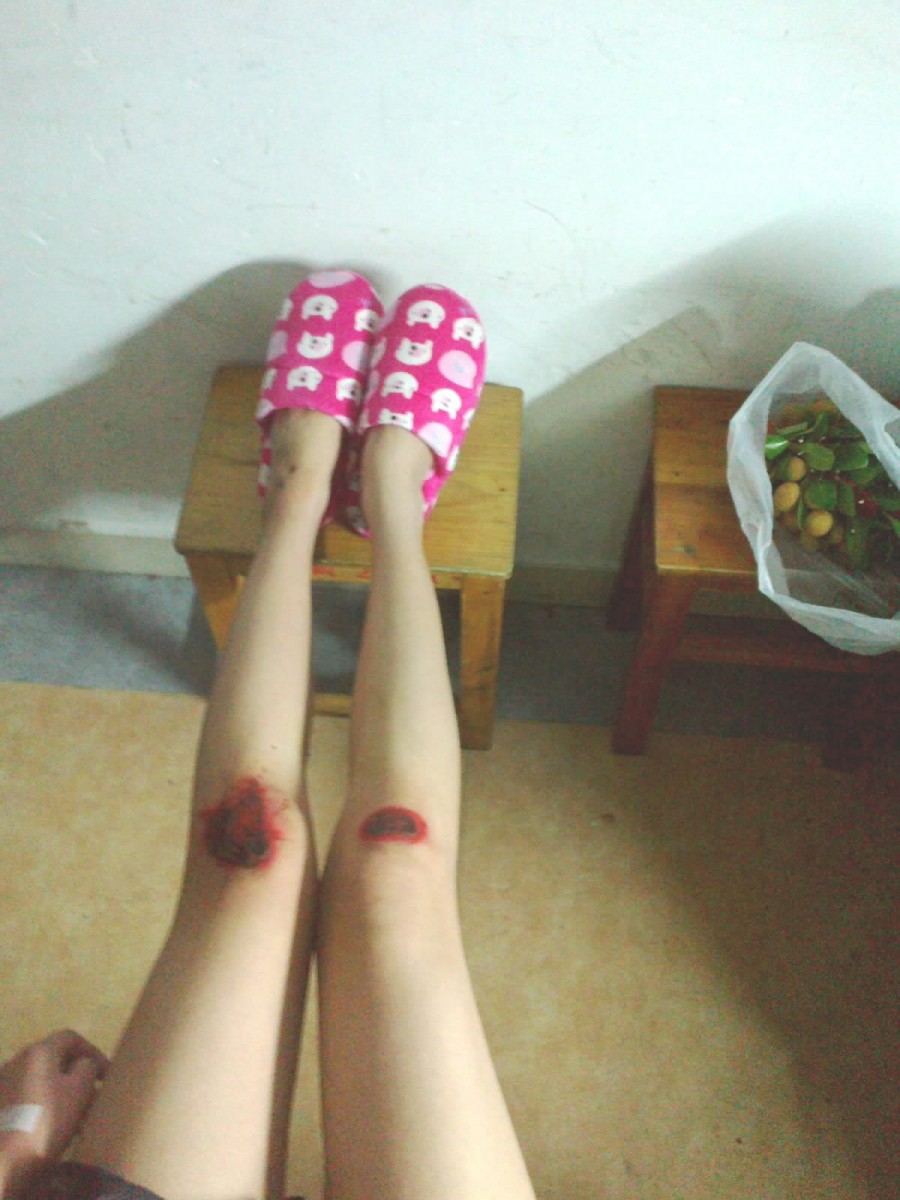 美女膝蓋發(fā)紫了內(nèi)涵圖